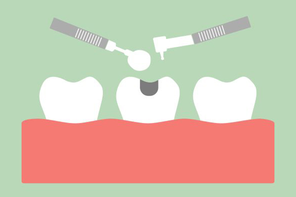 A Guide To Getting A Dental Filling From A Dentist