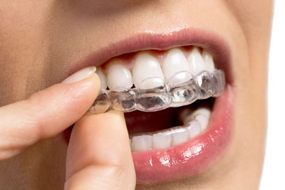 The Process Of Straightening Teeth From An Invisalign® Dentist