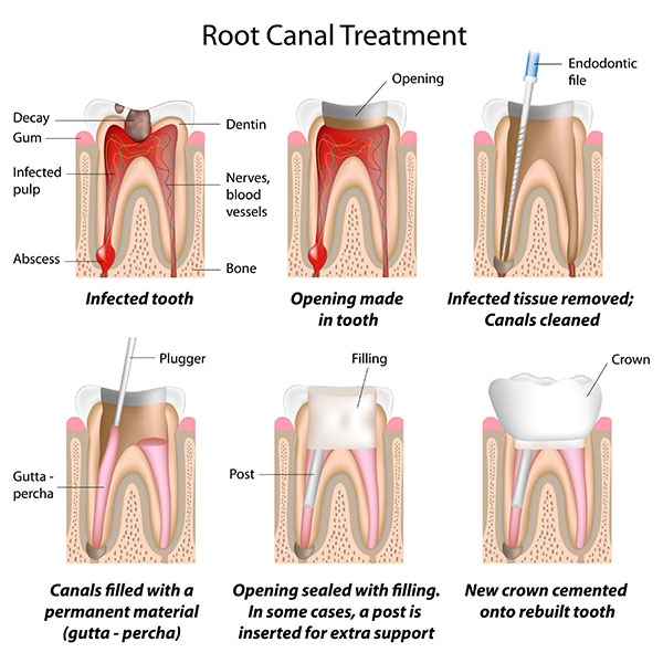 Why You May Need A Dental Crown After Root Canal Therapy