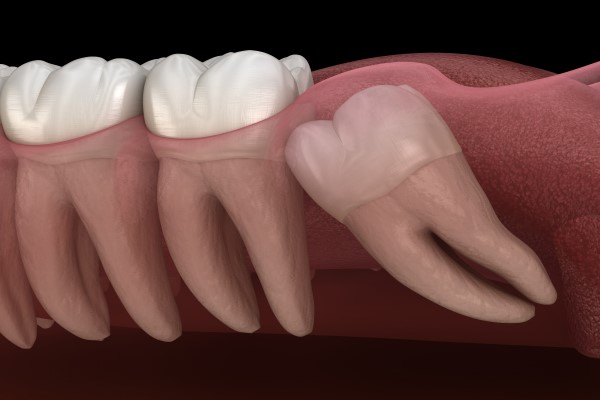 When You Should Get A Wisdom Tooth Extraction